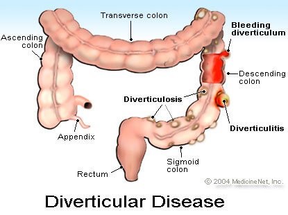 5 Diverticulitis Symptoms, Diverticulum, Pain, Diet, Treatment, and Surgery